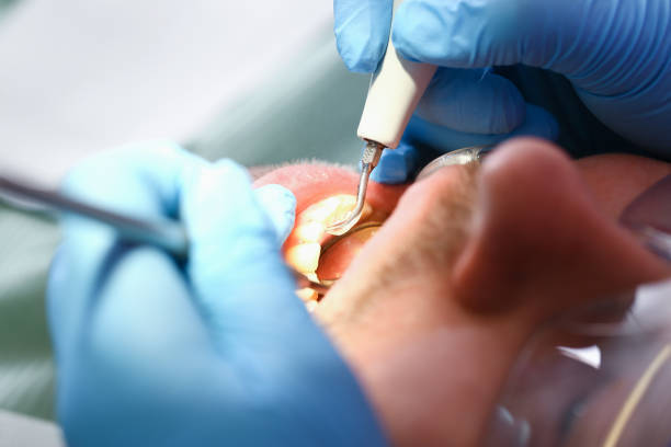 Best Emergency Tooth Extraction in Paincourtville, LA